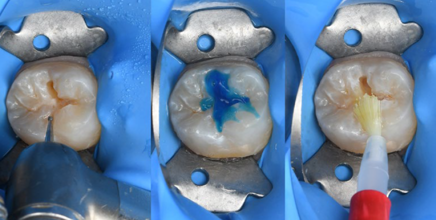 Fig. 8: Restoration procedure: From preparation to bonding.